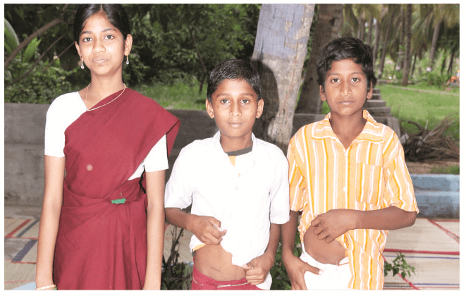 Children who underwent appendicectomy showing their scar